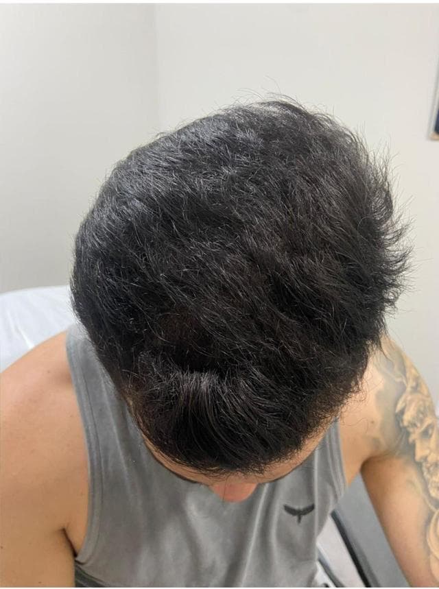 Patient 1 after hair restoration — restored density