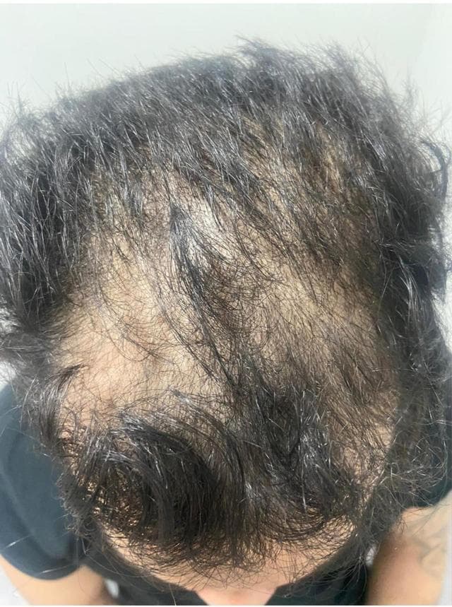 Patient 1 before hair restoration — diffuse thinning
