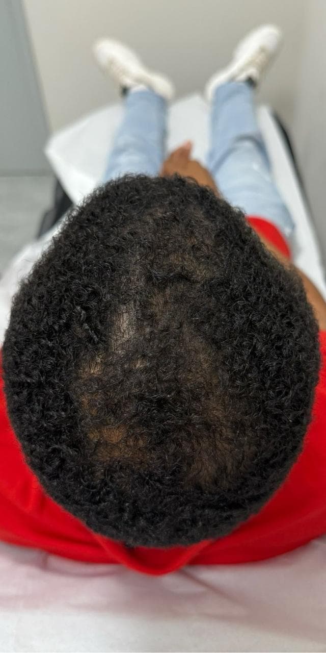 Patient 2 after hair restoration — regrowth
