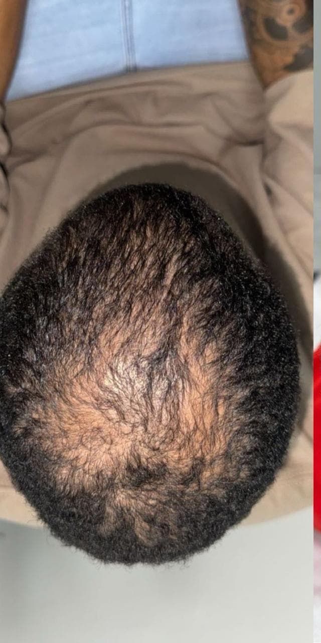 Patient 2 before hair restoration — crown thinning