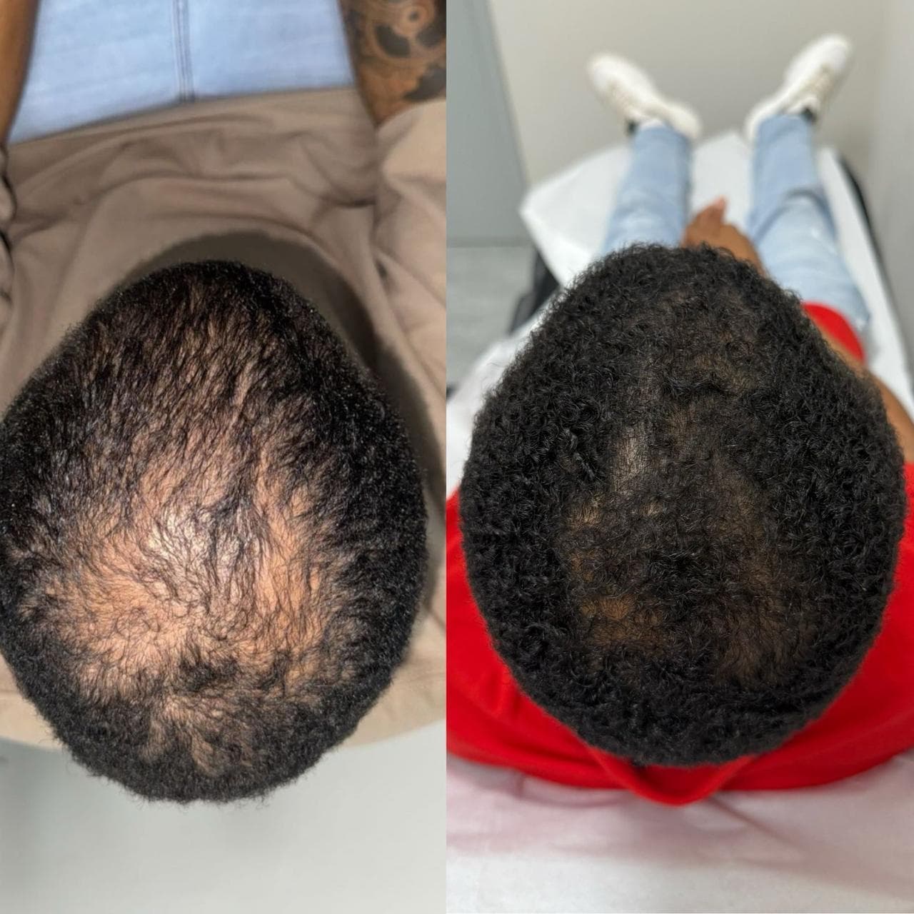 Male hair restoration patient